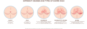Diaper Rash, Ruam Popok, Perawatan Luka, Ruam Popok Parah, Rua Popok Bayi, Ruam Popok Dewasa, Perawatan Luka